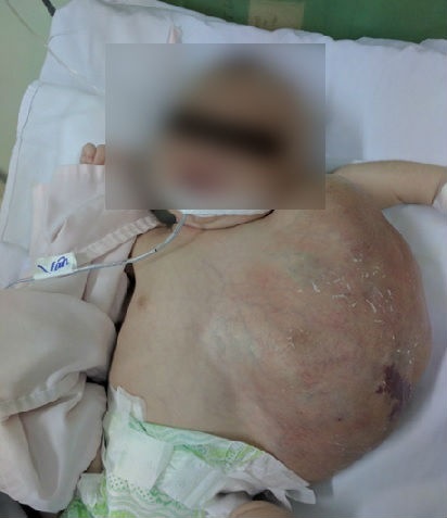 sơ sinh mang bướu khủng ảnh 1 so sinh mang buou khung anh 1