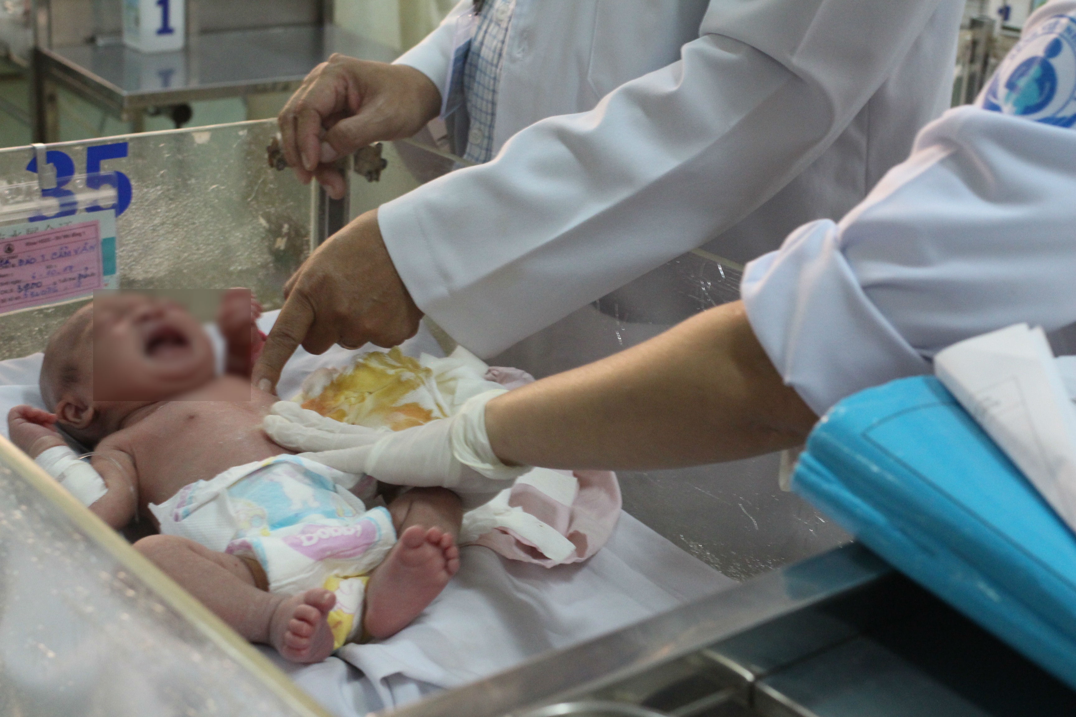 Be so sinh mang khoi buou bach huyet nang gan mot kg hinh anh