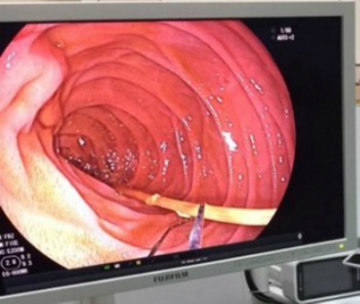 Nhap vien vi nuot 6 cay nhang chay do hinh anh