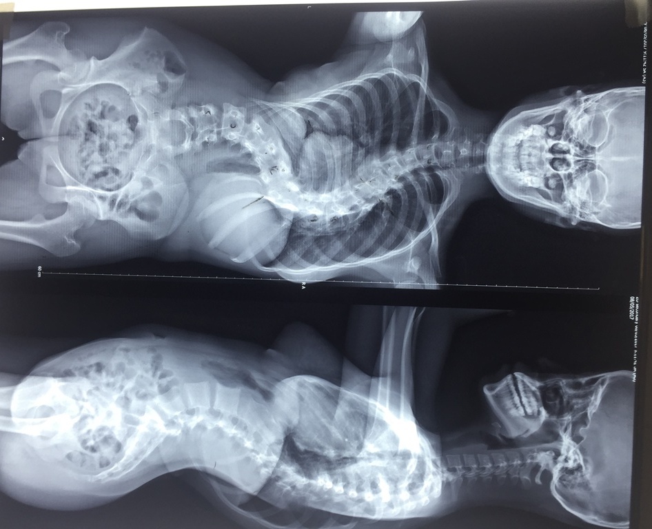 thiếu nữ cong vẹọ cột sống ảnh 1 thieu nu cong veo cot song anh 1