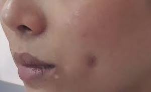 Ma lum dong tien bien thanh o ap-xe vi lam dep o tham my vien chui hinh anh