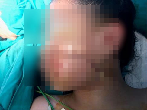 Khuon mat be gai mat mang thit lon sau khi bi cho can hinh anh