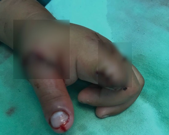 đứt lìa chi ảnh 1 dut lia chi anh 1