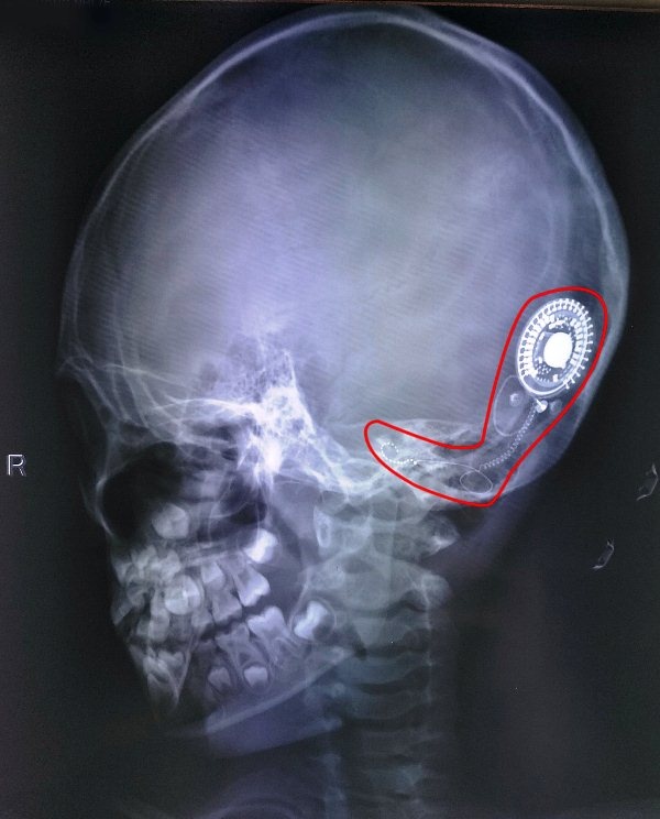 Co be 7 tuoi thoat canh cam diec suot doi nho cay dien cuc oc tai hinh anh