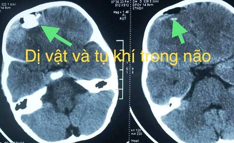 Nghich sung ban dan bi, be trai bi chan thuong so nao hinh anh