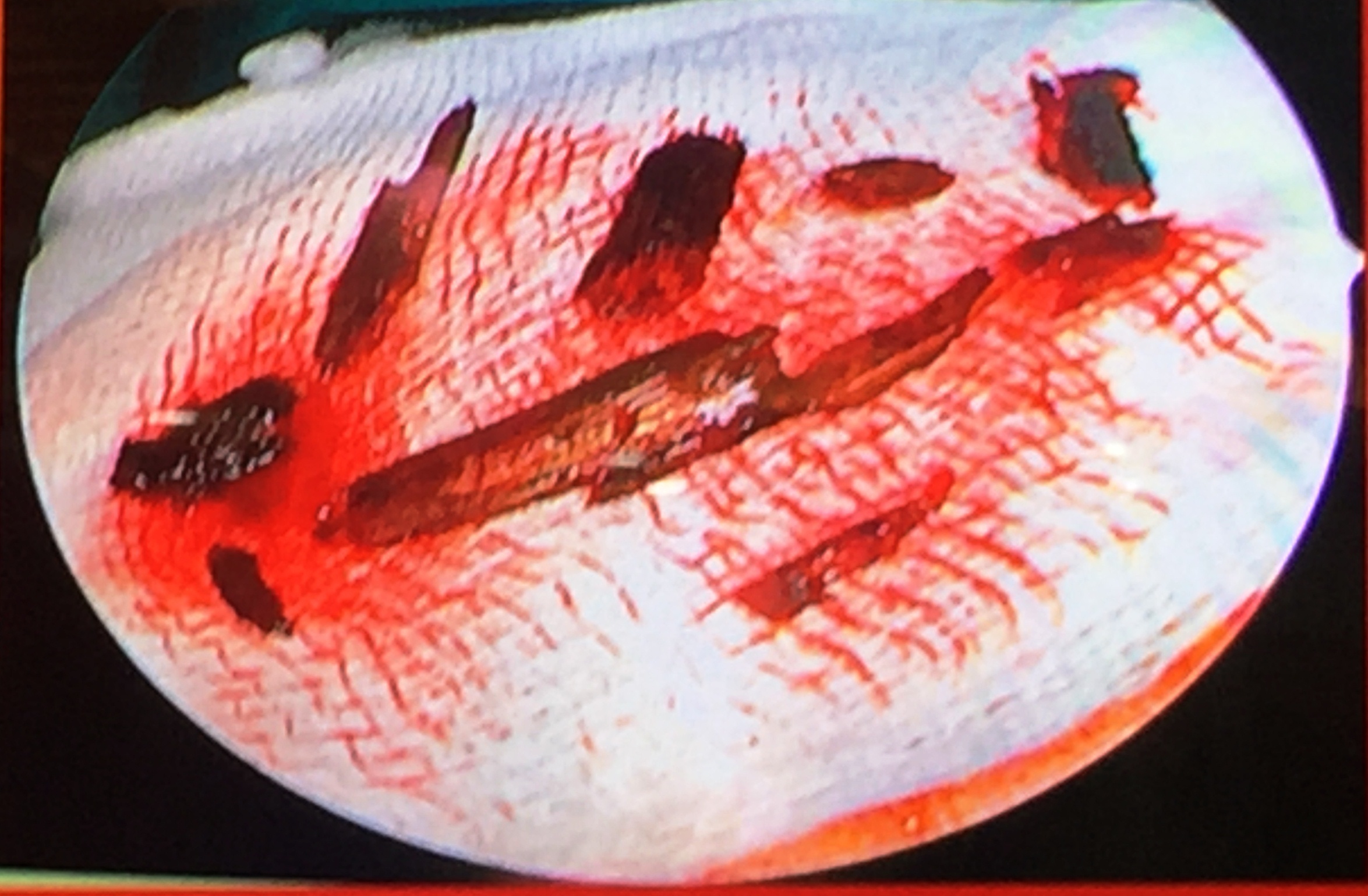 Gap 10 mieng dam go ket trong hoc mat nguoi dan ong hinh anh