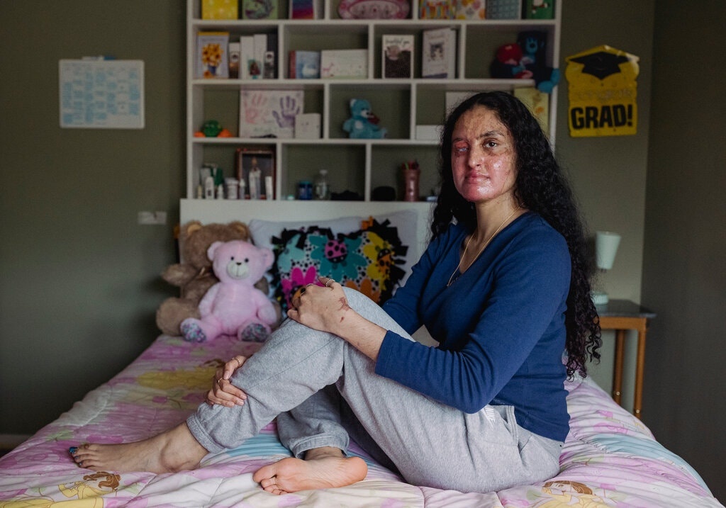 co gai goc A bi tat axit vao mat anh 1