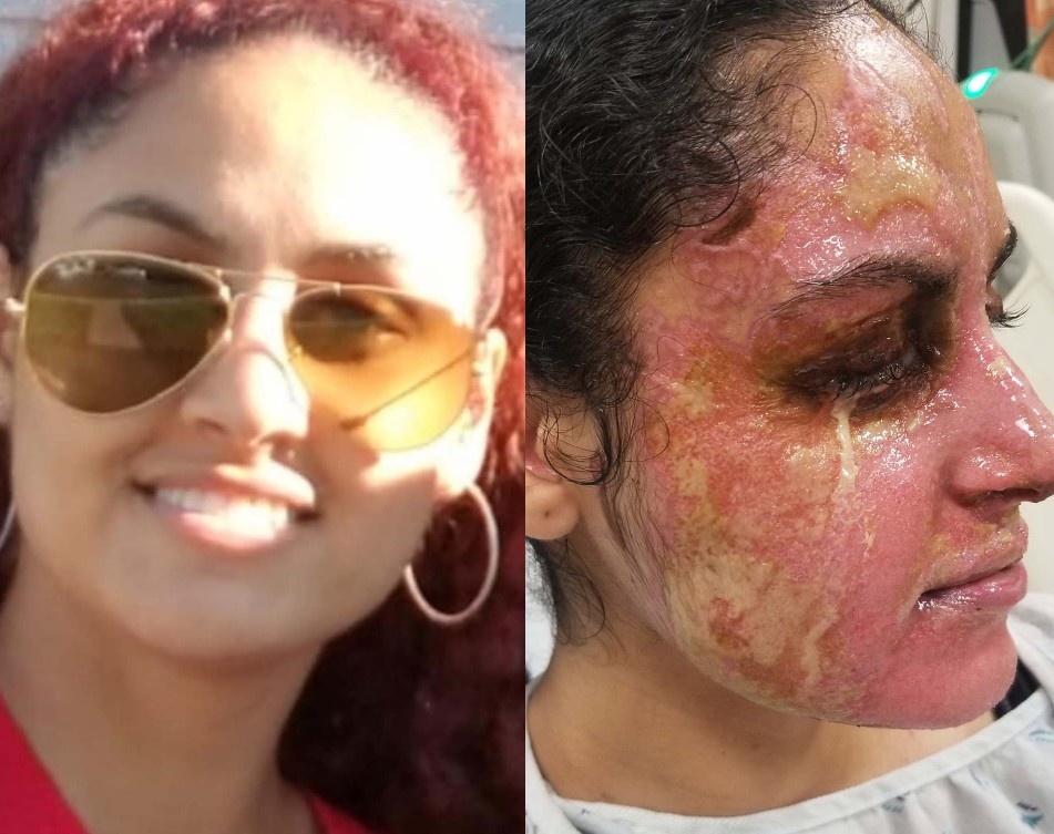 Co gai goc A bi nguoi dan ong vo co tat axit vao mat hinh anh