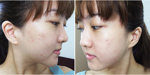 Thành phần corticosteroid có trong kem lột trắng đã khiến da của Juli bị tổn thương, mọc mụn, rối loạn sắc tố.