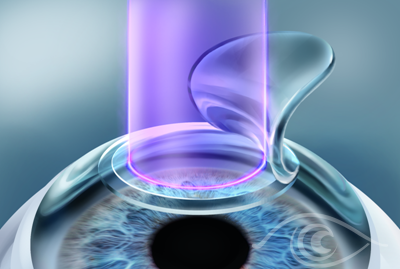 phẫu thuật mắt tại Trung tâm Mắt kỹ thuật cao ảnh 2 phau thuat mat tai Trung tam Mat ky thuat cao anh 2