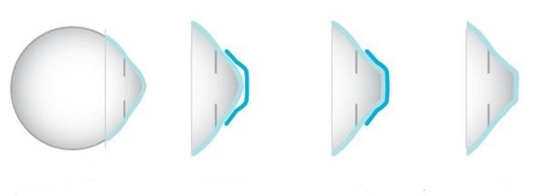 Điều trị cận thị không phẫu thuật bằng kính OrthoK ảnh 1 Dieu tri can thi khong phau thuat bang kinh OrthoK anh 1