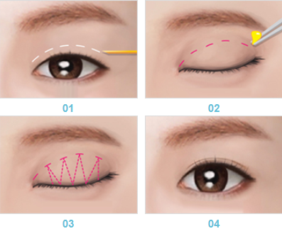 phau thuat tao mat 2 mi anh 1