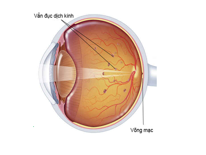 Hiện tượng ruồi bay sau khi mổ đục thuỷ tinh thể ảnh 1 Hien tuong ruoi bay sau khi mo duc thuy tinh the anh 1