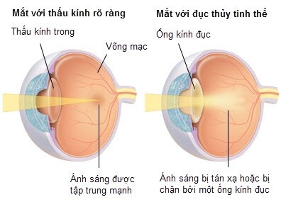 Hiện tượng ruồi bay sau khi mổ đục thuỷ tinh thể ảnh 2 Hien tuong ruoi bay sau khi mo duc thuy tinh the anh 2