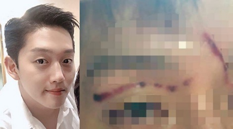 Ban trai he lo vet thuong tren mat do 'Bup be xu Han' Goo Hara gay ra hinh anh