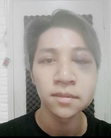 bui duy ngoc tai nan chan thuong anh 2