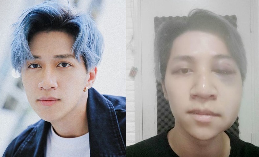 Ca si Bui Duy Ngoc chan thuong nao, liet nua mat vi tai nan hinh anh