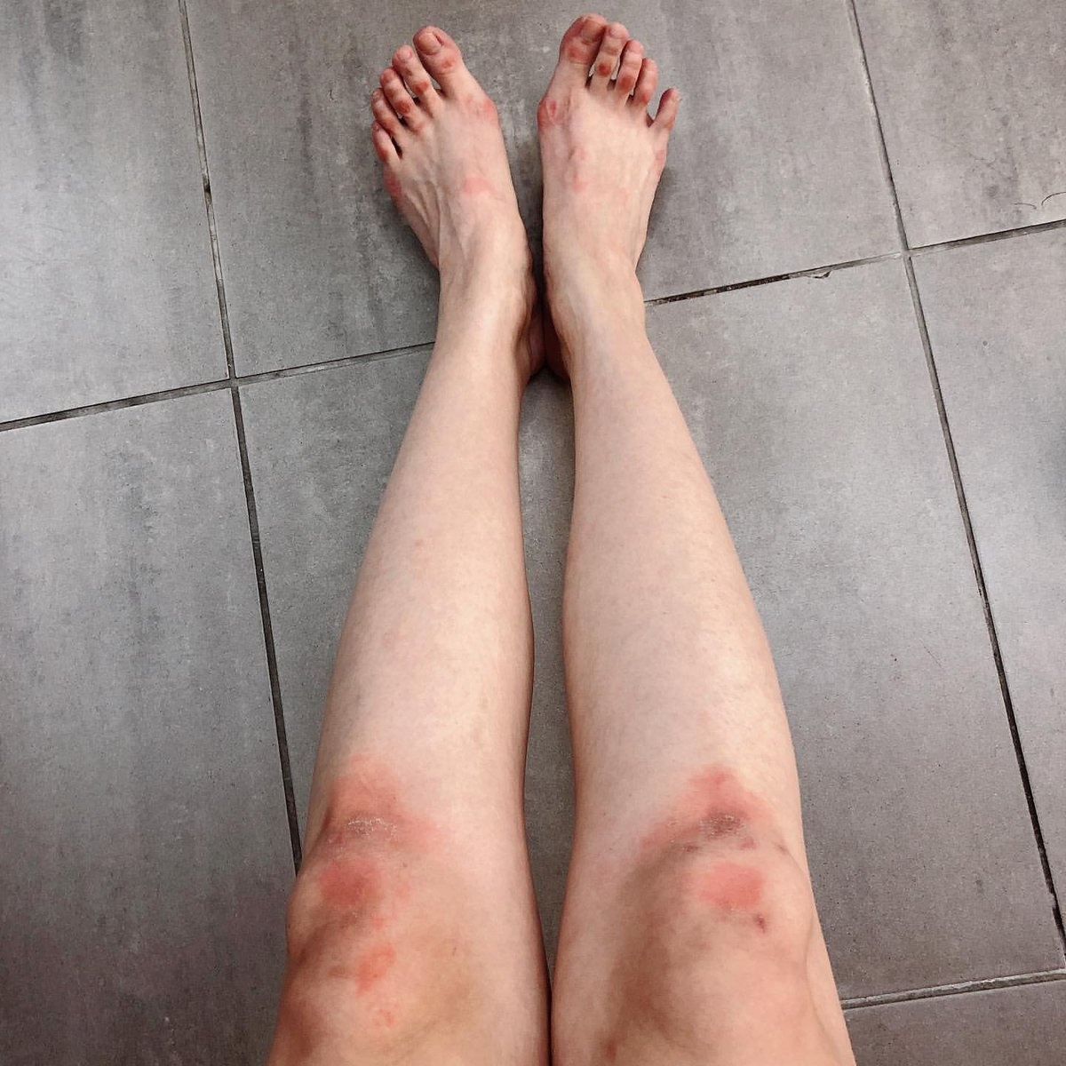 sunmi bi thuong vi vu dao anh 6