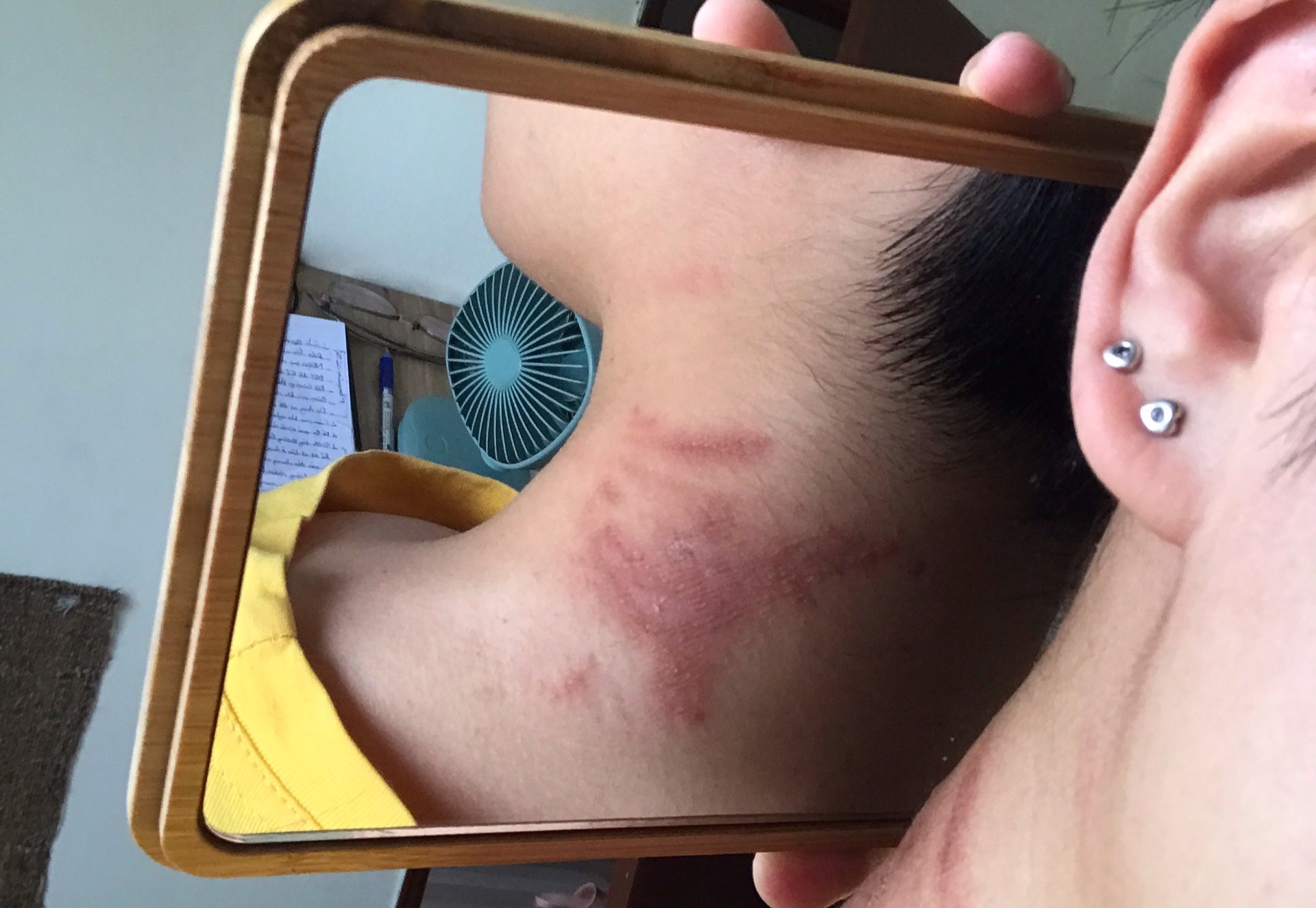 Cu dan o TP.HCM bi phong rop, dau rat da vi kien ba khoang  hinh anh