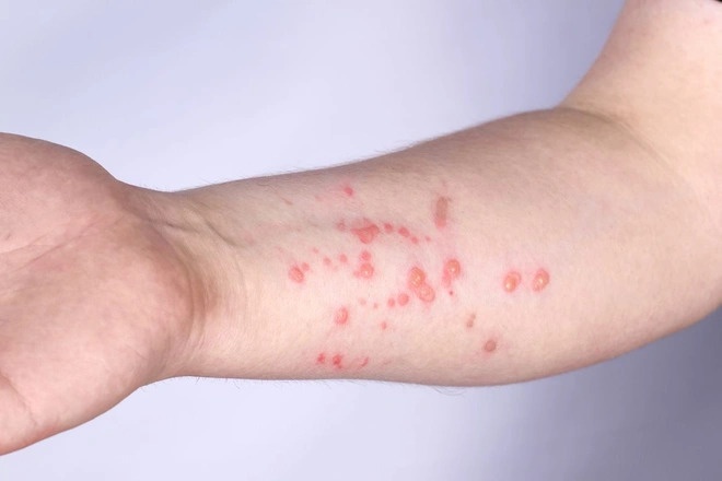 Thong tin suc khoe cua benh nhan mac dau mua khi dau tien o Viet Nam hinh anh