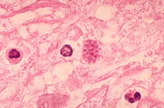 Toxoplasmosis là bệnh gây ra bởi loại kí sinh trùng mang tên Toxoplasma Gondii. Loại ký sinh này thường được tìm thấy ở một số động vật, đặc biệt là mèo. Việc bạn bị nhiễm Toxoplasma trong quá trình mang thai có thể sẽ không ảnh hưởng tới thai nhi, nhưng cũng có trường hợp thai nhi bị tổn thương nghiêm trọng ở não bộ và mắt.