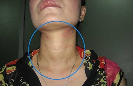 Một bệnh nhân sau khi sử dụng mỹ phẩm đã phải đến BV Da liễu vì những vết nổi mẩn trên cổ.