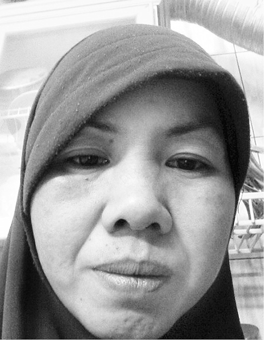 Chị Huỳnh Ngọc Bích bị chủ đánh bầm mặt vì không làm được việc khi bị ốm.