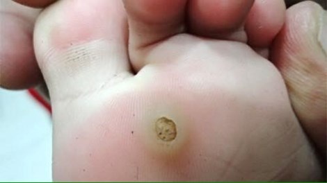 Mụn cóc là do một loại virus xâm nhập vào cơ thể qua vết nứt trên da.