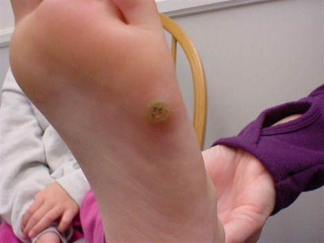 Không ít người không phát hiện ra mình đã bị mụn cóc vì nhầm lẫn với vết chai trên chân.