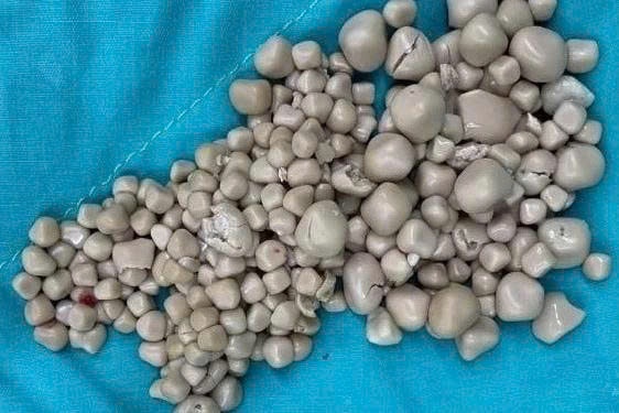 sỏi thận  ảnh 1