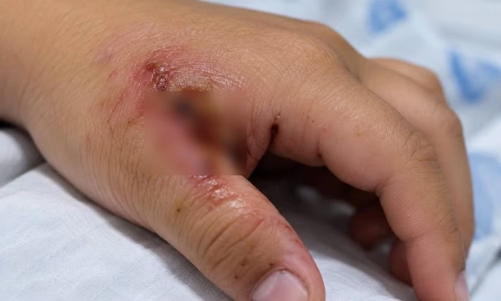 Uốn ván nặng, bé trai 7 tuổi co giật liên tục