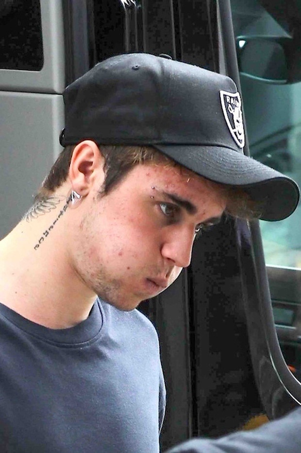 Justin Bieber công bố căn bệnh khiến anh bị hiểu lầm là nghiện ma túy ảnh 2 Justin Bieber cong bo can benh khien anh bi hieu lam la nghien ma tuy anh 2