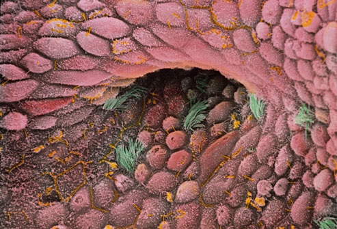 Dấu hiệu ung thư buồng trứng ảnh 3 Dau hieu ung thu buong trung anh 3