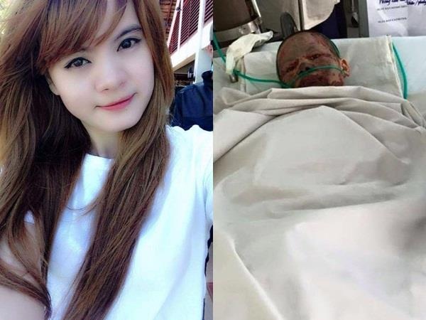 Dan mang xot thuong co gai bi ban trai tuoi xang thieu song hinh anh