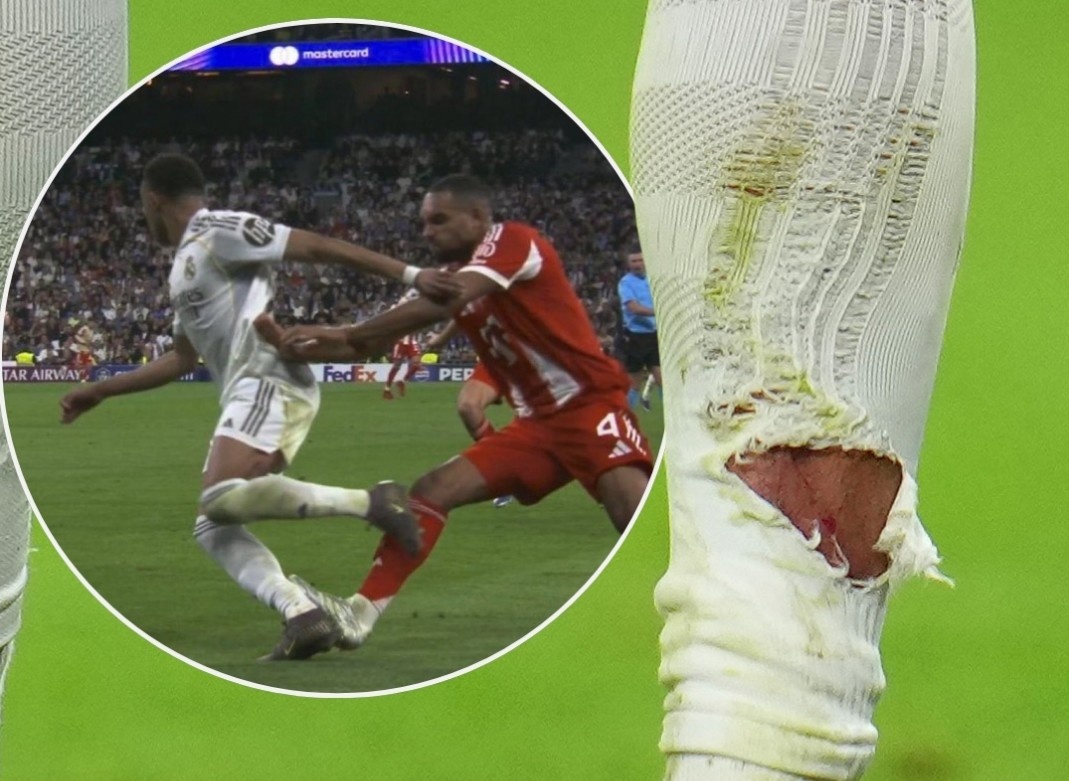 Vet thuong gay lo lang cua Mbappe hinh anh