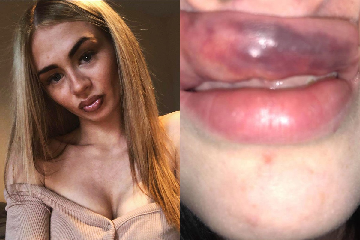 Moi bi sung phong, tu mau vi tiem filler kem chat luong hinh anh