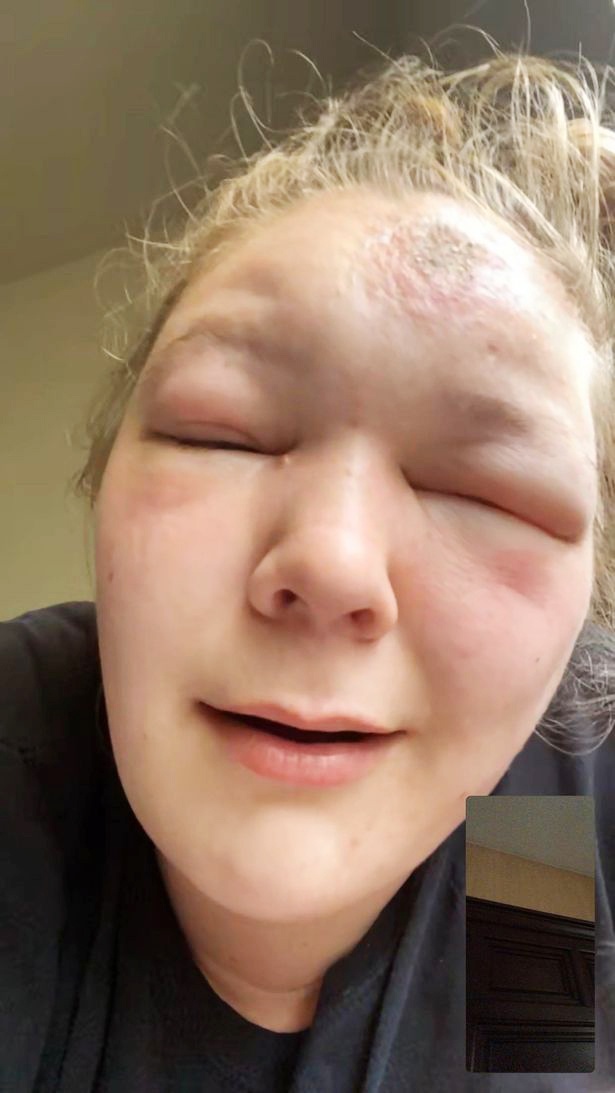 Co gai bi sung phong mat anh 2