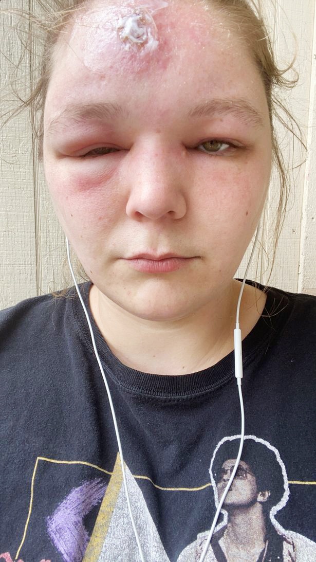 Co gai bi sung phong mat anh 3