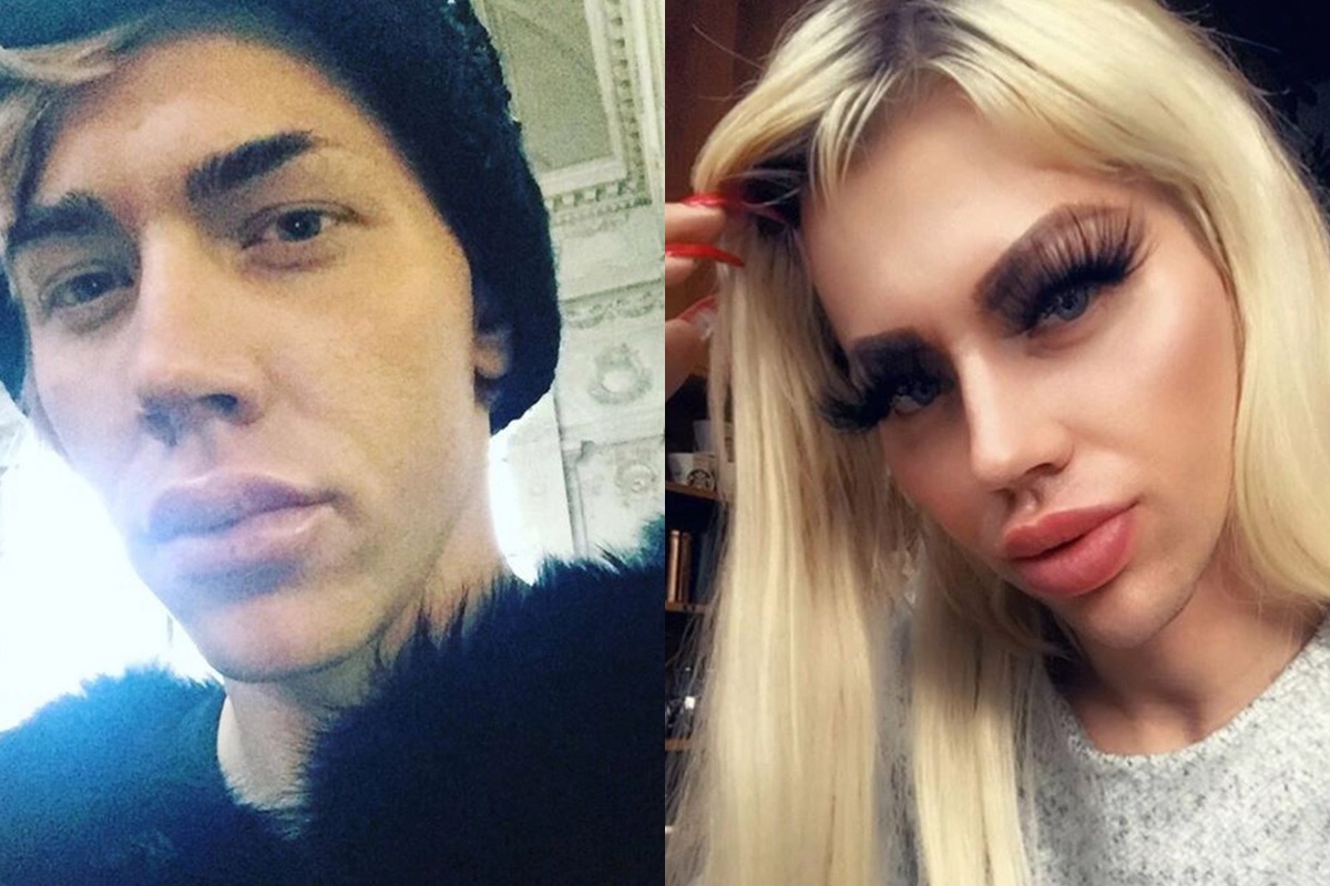 Chang trai chi 19.000 USD phau thuat giong bup be Barbie hinh anh