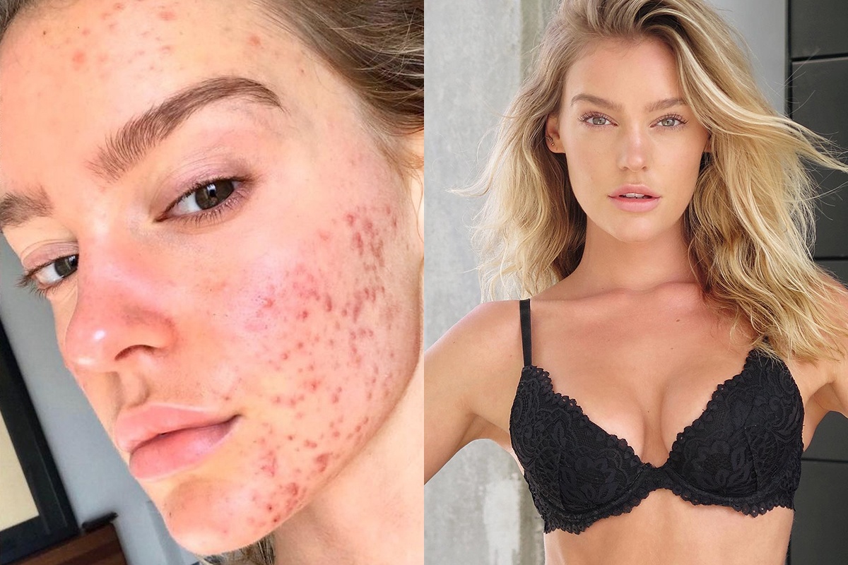 Nu nguoi mau tiet lo cach chua het mun hinh anh