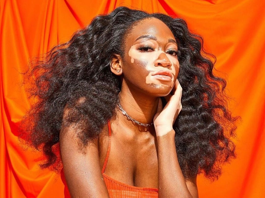 Nu nguoi mau co lan da bach bien dac biet hinh anh