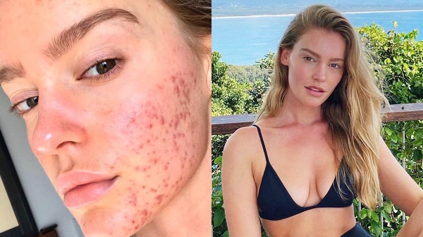 Bi quyet ngan ngua mun de thuc hien hinh anh