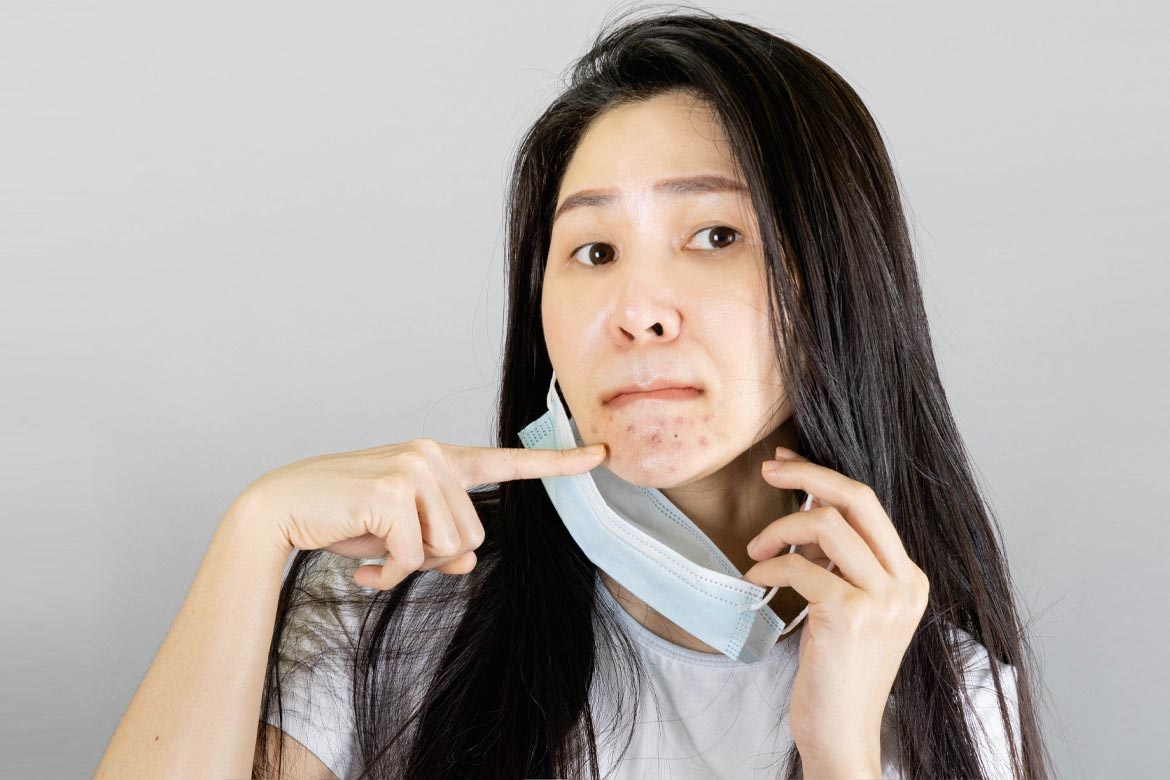 nguyen nhan gay mun anh 1