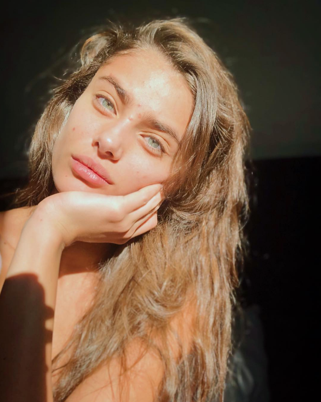 nguyen nhan gay mun anh 2