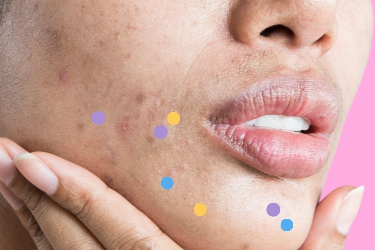 nguyen nhan gay mun anh 6