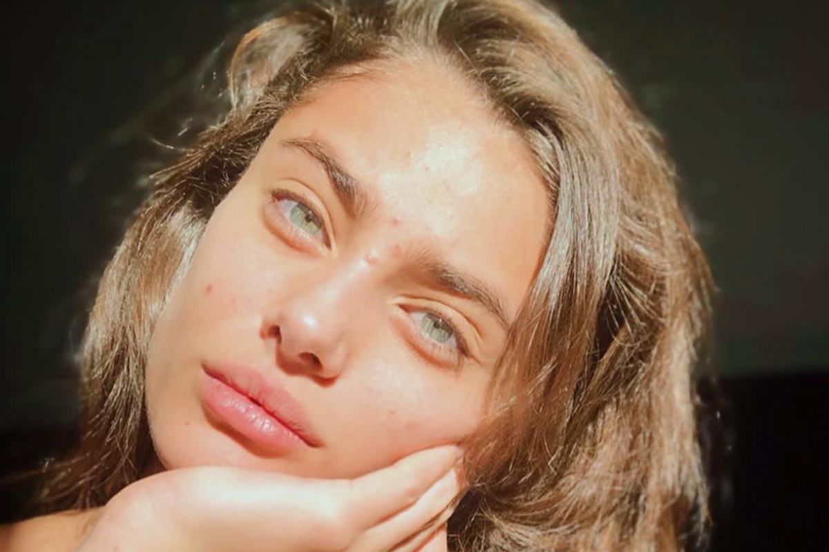 Nhung nguyen nhan lam ban de noi mun hinh anh