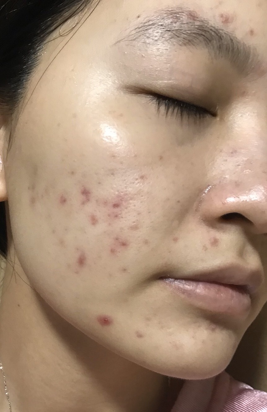 cach tri mun noi tiet anh 2