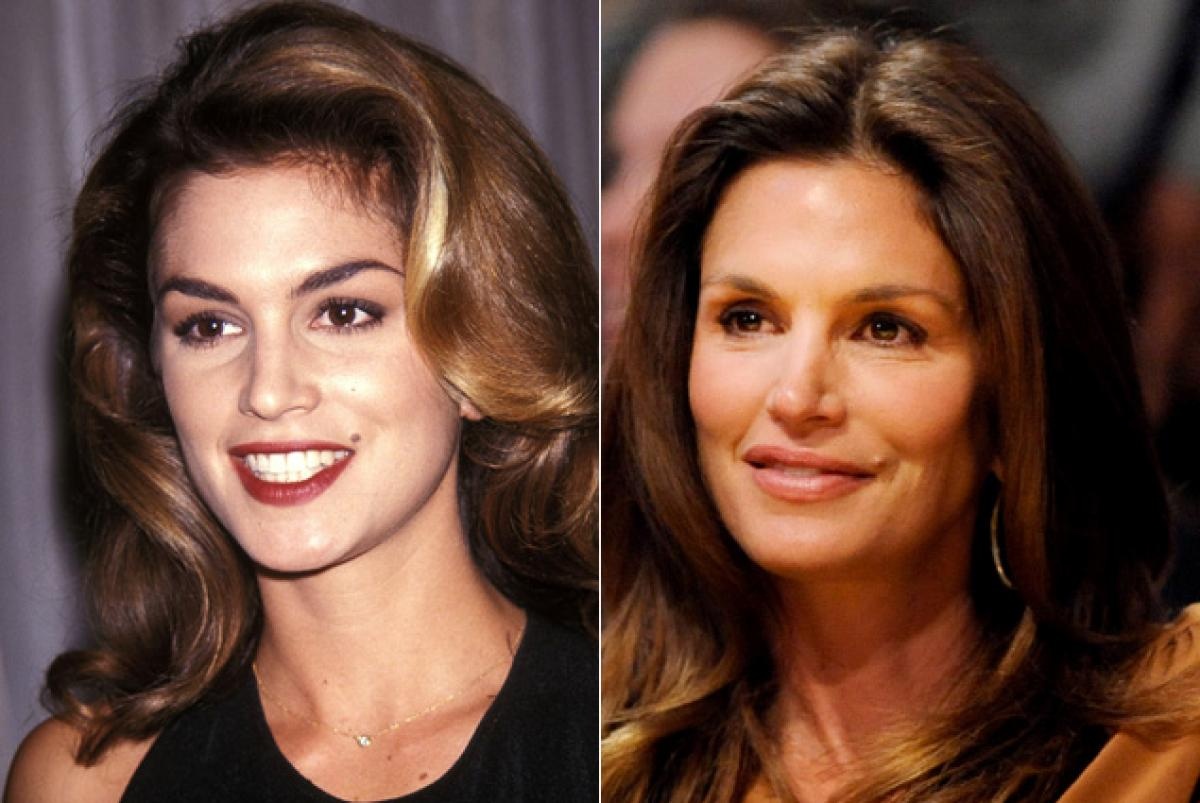 Ngoài Botox, cựu siêu mẫu Cindy Crawford còn thừa nhận sử dụng thêm tiêm collagen và vitamin để giữ ngoại hình tứ tuần xinh đẹp. Điều này giải thích lý do tại sao Cindy không thể biểu hiện được nhiều cảm xúc vì cơ mặt đã cứng đơ.