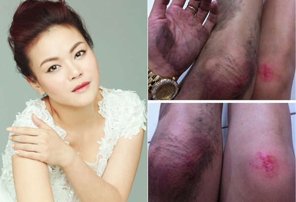 Ca  sĩ Hải Yến idol cũng không may gặp cướp giữa ban ngày, tháng  4 vừa qua, Hải Yến rời khỏi event tại một khách sạn ở trung tâm Tp.HCM, trong lúc vừa lên xe và chuẩn bị mặc áo mưa, một tên cướp chạy ngang giật lắc tay khiến nữ ca sĩ ngã nhào, xây xát chân tay nhưng may mắn không bị mất tài sản.  