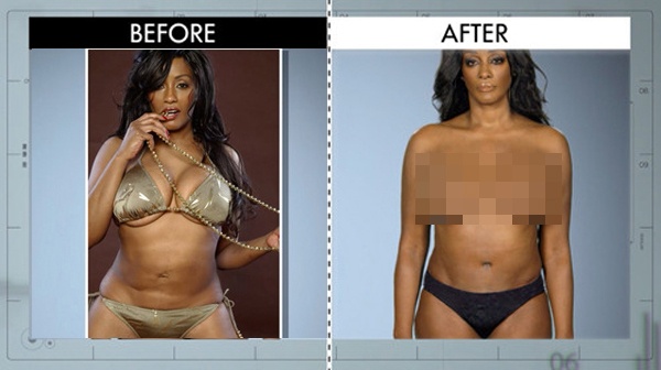 Bệnh nhân này là Saaphyri – một ngôi sao truyền hình thực tế, cô từng làm phẫu thuật vùng bụng nhưng người bác sĩ thực hiện ca phẫu thuật lại để lại một vết sẹo dài khá rõ. Đó cũng là người đã nâng ngực cho Saaphyri nhưng kết quả không được như ý muốn. Bác sĩ Terry Dubrow đã chỉnh sửa, xóa vết sẹo trên bụng và giúp vòng 1 của Saaphyri trông tự nhiên hơn.